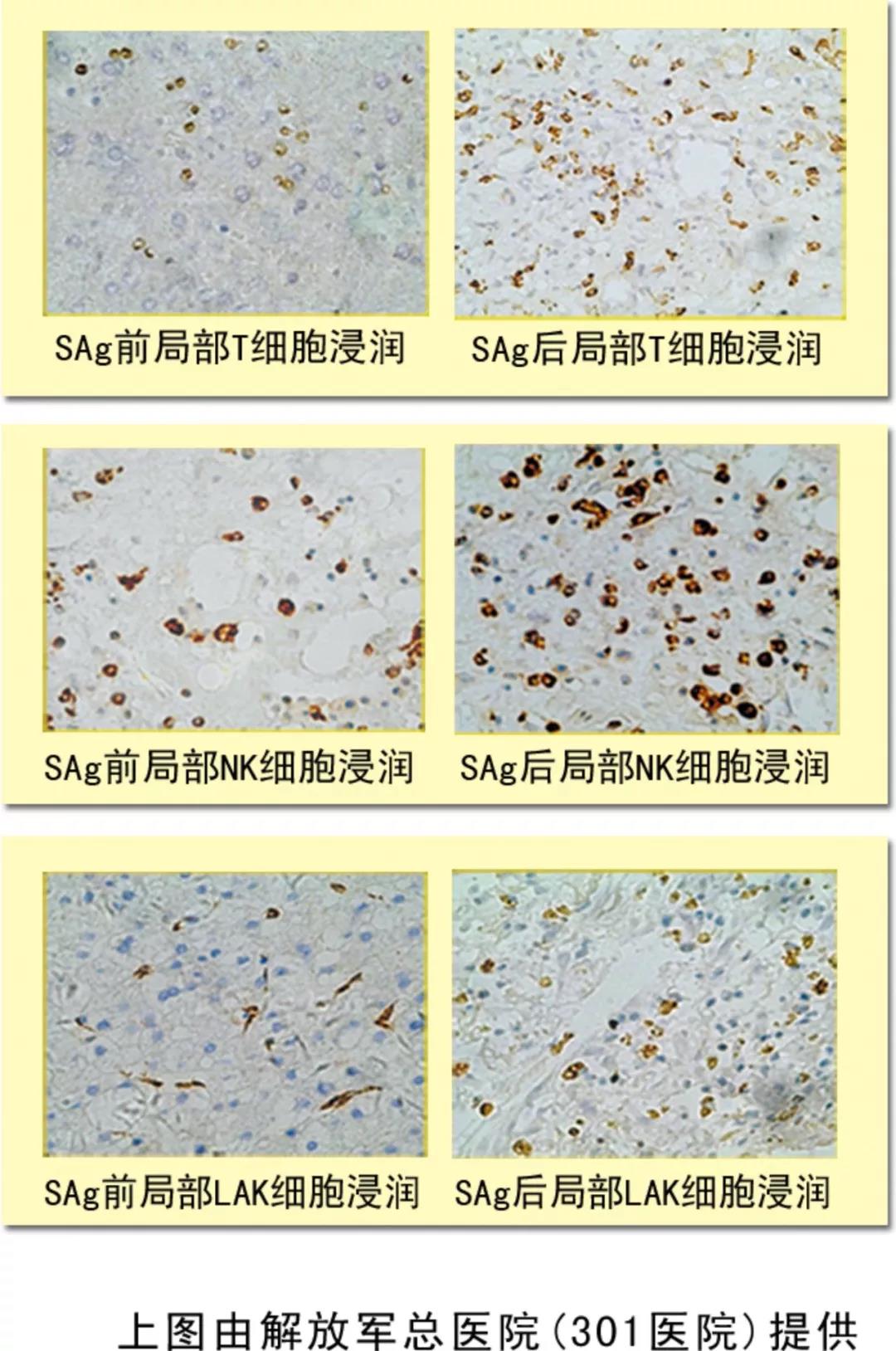 NK细胞，抗癌的第一道防线